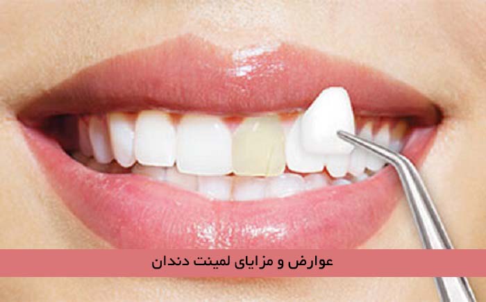 عوارض و مزایای لمینت دندان