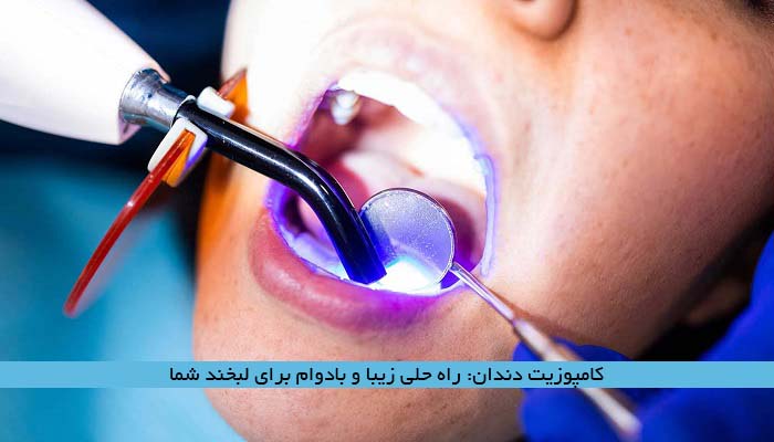 کامپوزیت دندان: راه حلی زیبا و بادوام برای لبخند شما