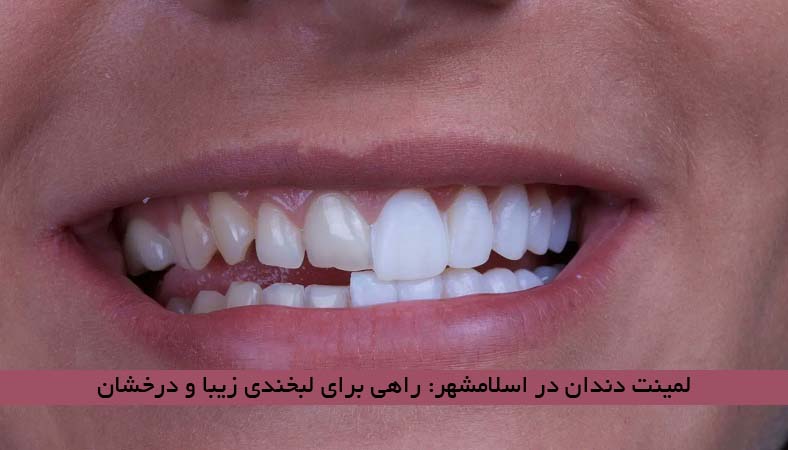 لمینت دندان در اسلامشهر: راهی برای لبخندی زیبا و درخشان