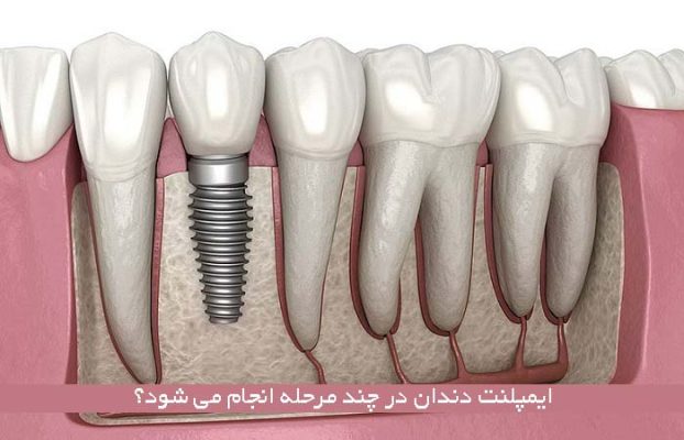 ایمپلنت دندان در چند مرحله انجام می شود؟