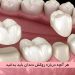 روکش دندان در اسلامشهر
