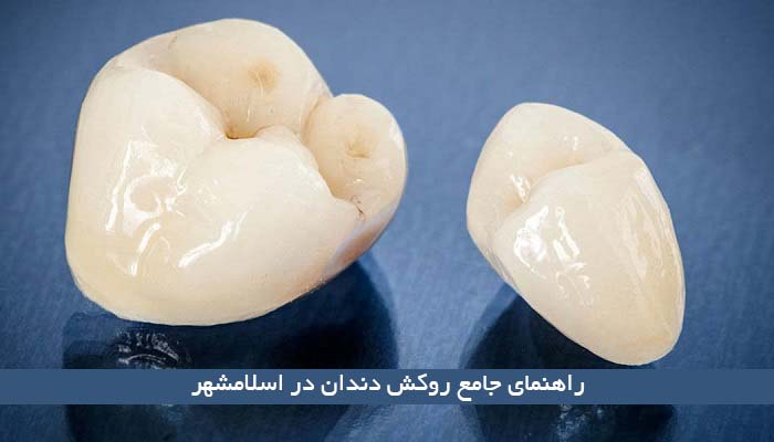 راهنمای جامع روکش دندان در اسلامشهر