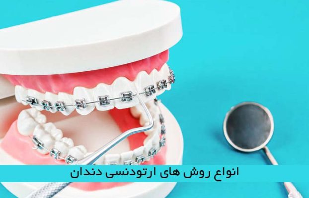 انواع روش های ارتودنسی دندان