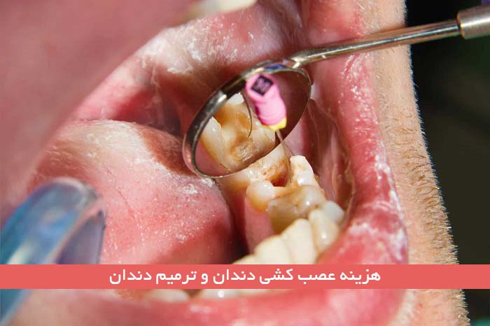 جدیدترین هزینه عصب کشی دندان و ترمیم دندان در سال ۱۴۰۳