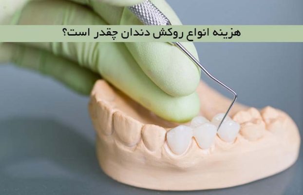 هزینه انواع روکش دندان چقدر است؟