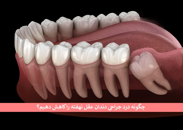 چگونه درد جراحی دندان عقل نهفته را کاهش دهیم؟