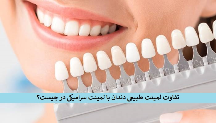 تفاوت لمینت طبیعی دندان با لمینت سرامیکی در چیست؟