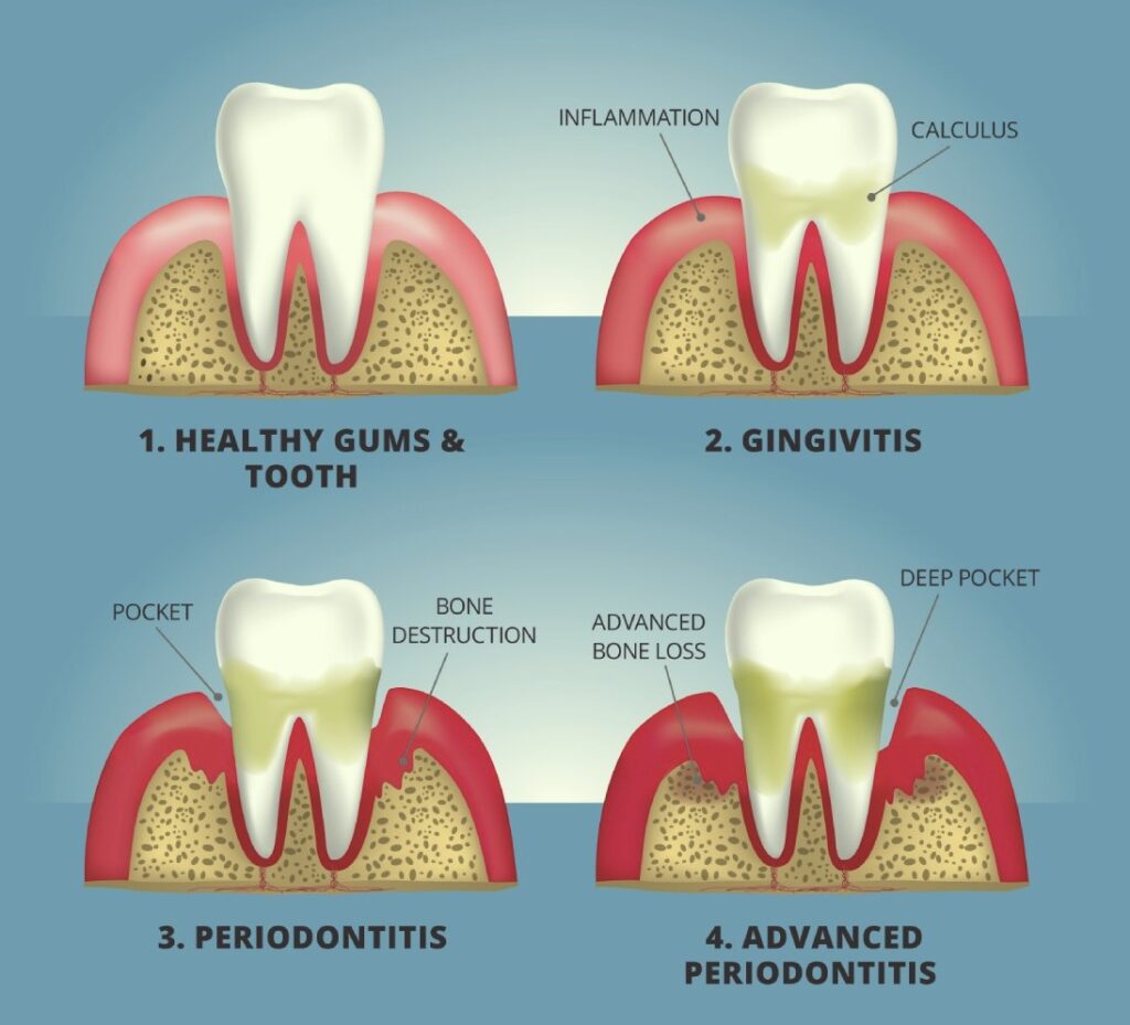 تاثیر دیابت بر دندان ها