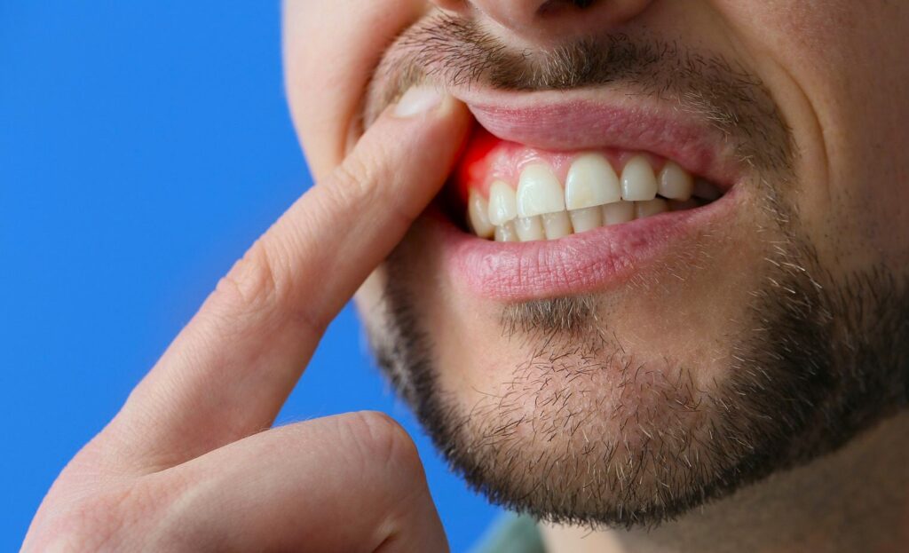 درد لثه هنگام مسواک زدن