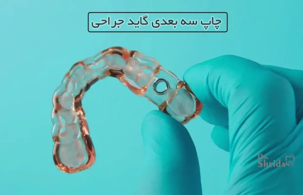 چاپ سه بعدی گاید جراحی ایمپلنت دندان
