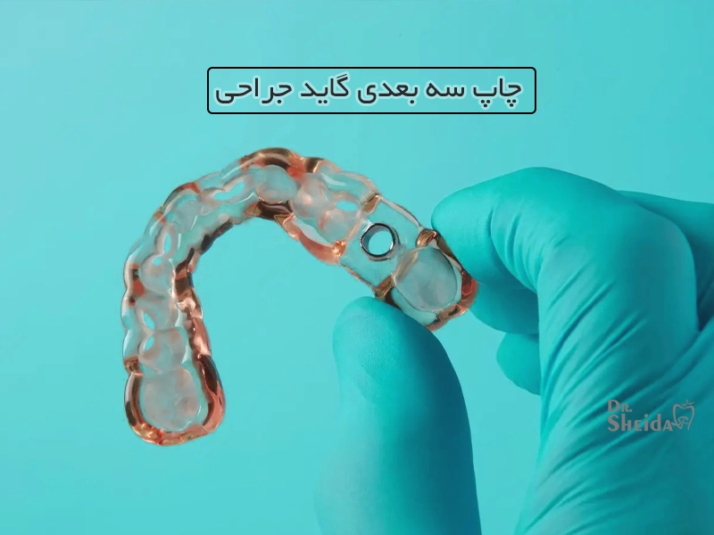 چاپ سه بعدی گاید جراحی ایمپلنت دندان