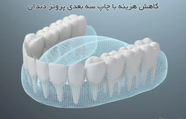چاپ سه بعدی پروتز و کاهش قیمت آن