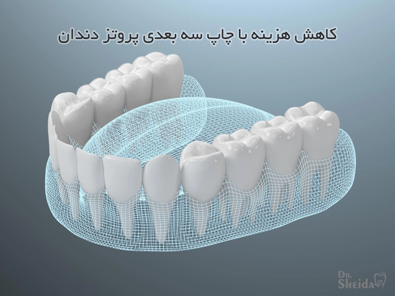 چاپ سه بعدی پروتز و کاهش قیمت آن